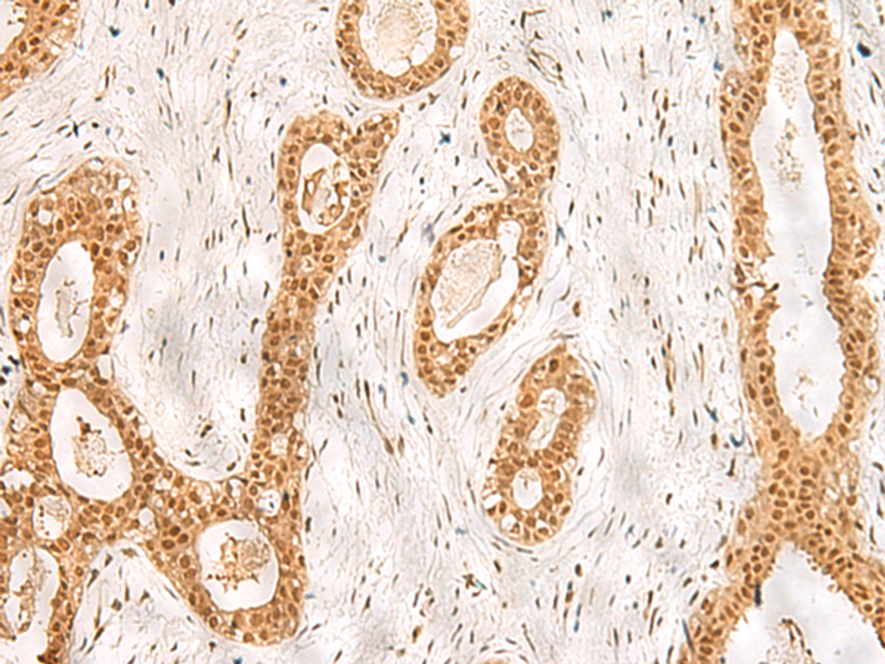 Immunohistochemistry of paraffin-embedded Human breast cancer tissue  using RPS27A Polyclonal Antibody at dilution of 1:40(×200)