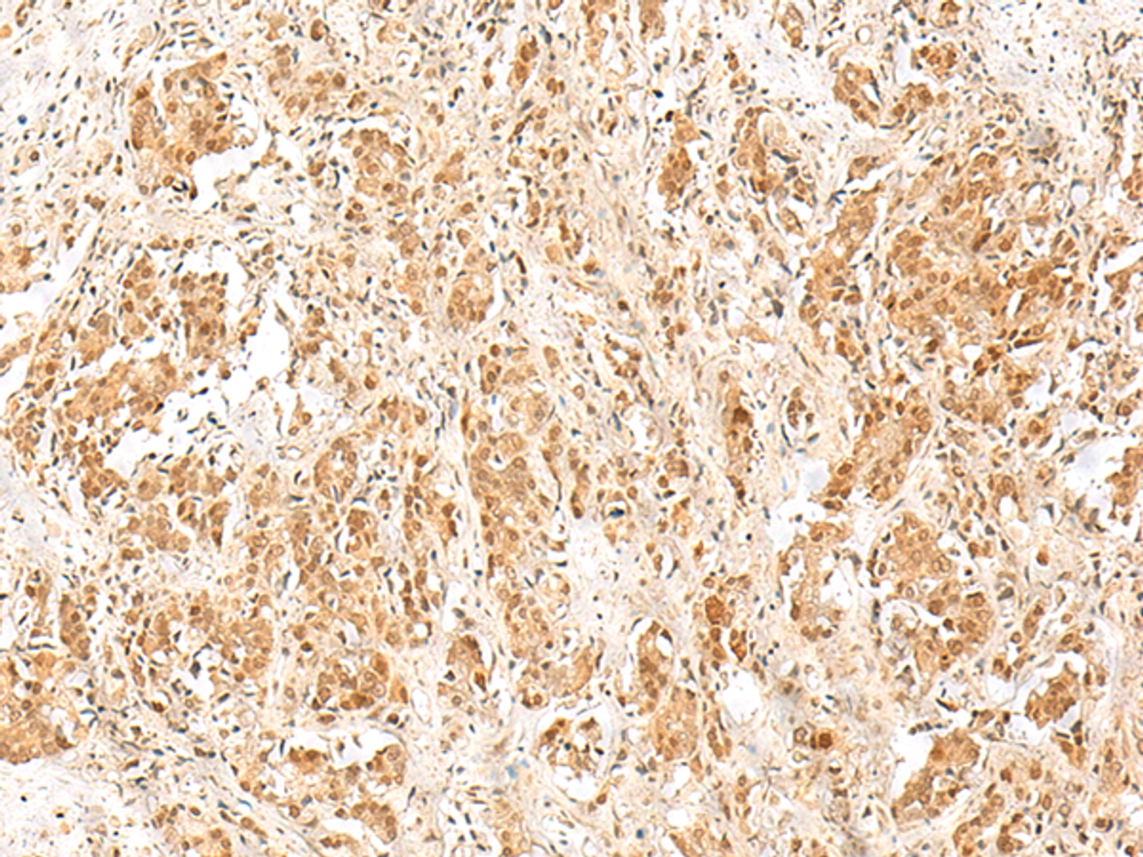 Immunohistochemistry of paraffin-embedded Human prost ate cancer tissue  using RPS27A Polyclonal Antibody at dilution of 1:40(×200)