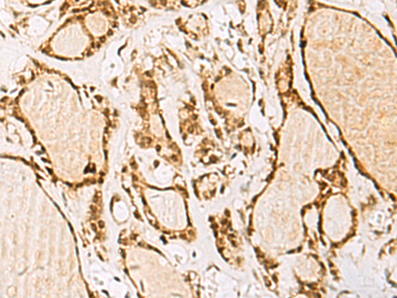 Immunohistochemistry of paraffin-embedded Human thyroid cancer tissue  using NIPBL Polyclonal Antibody at dilution of 1:55(×200)