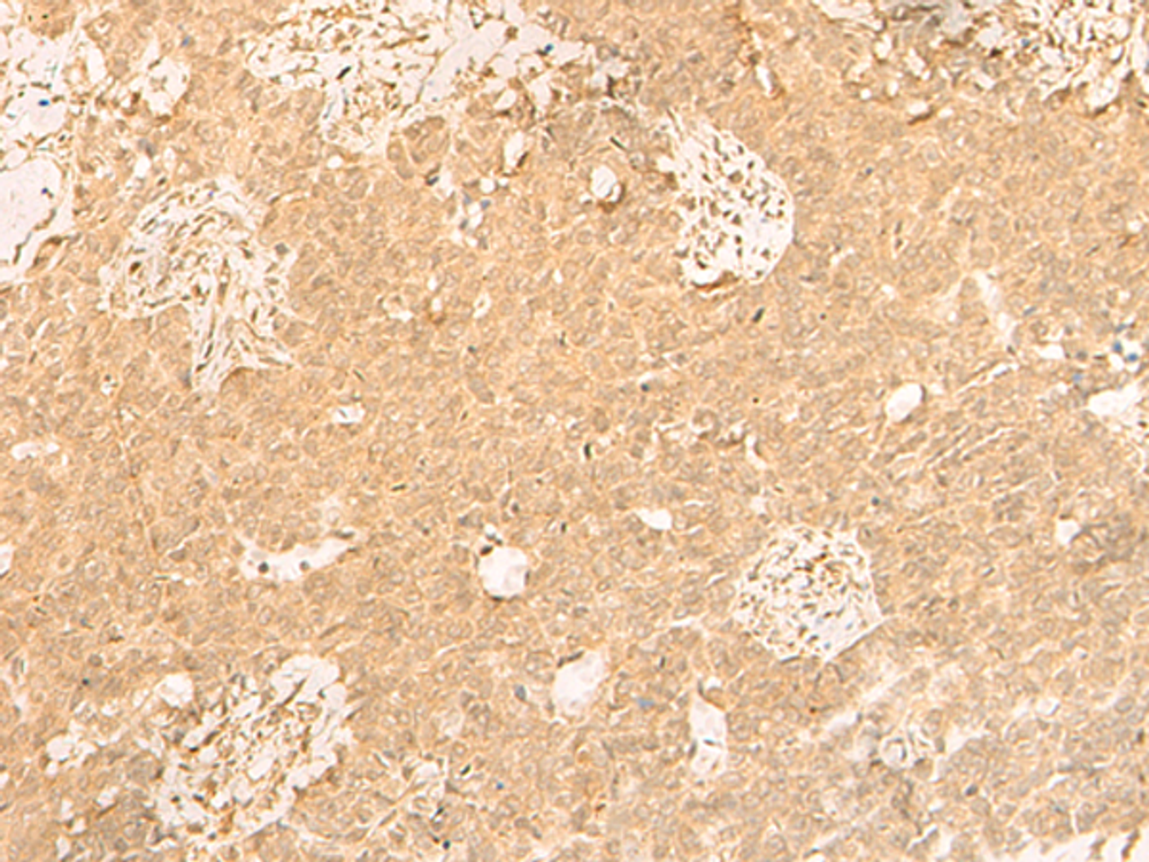 Immunohistochemistry of paraffin-embedded Human ovarian cancer tissue  using GSG1L Polyclonal Antibody at dilution of 1:50(×200)