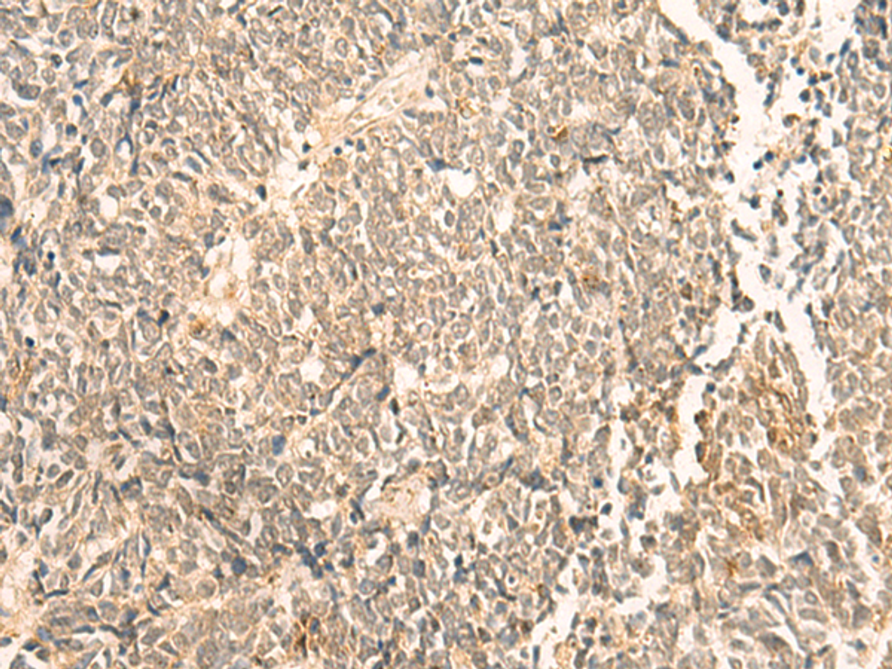 Immunohistochemistry of paraffin-embedded Human lung cancer tissue  using NIP7 Polyclonal Antibody at dilution of 1:50(×200)