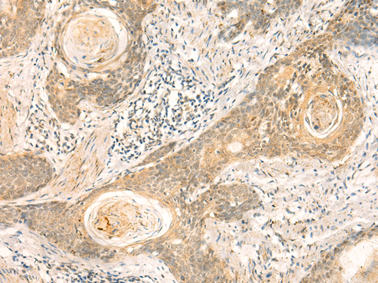 Immunohistochemistry of paraffin-embedded Human esophagus cancer tissue  using NIP7 Polyclonal Antibody at dilution of 1:50(×200)