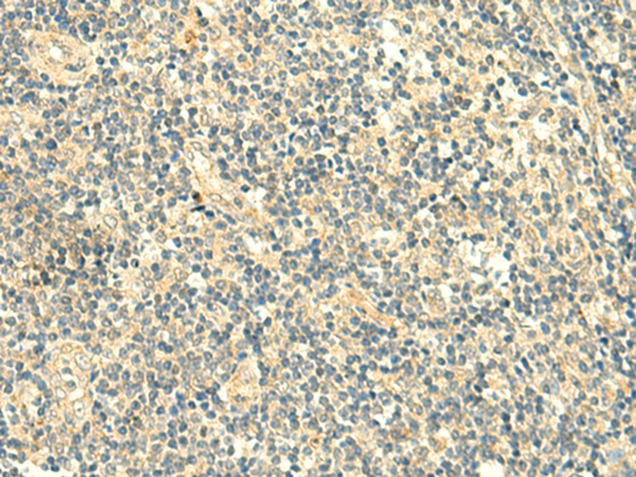 Immunohistochemistry of paraffin-embedded Human tonsil tissue  using TMEM9 Polyclonal Antibody at dilution of 1:50(×200)
