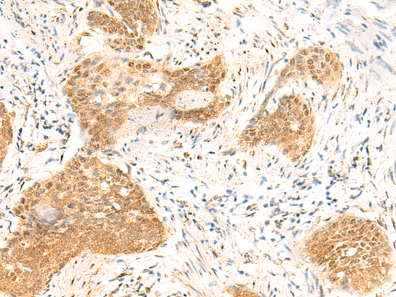 Immunohistochemistry of paraffin-embedded Human esophagus cancer tissue  using TBPL1 Polyclonal Antibody at dilution of 1:50(×200)