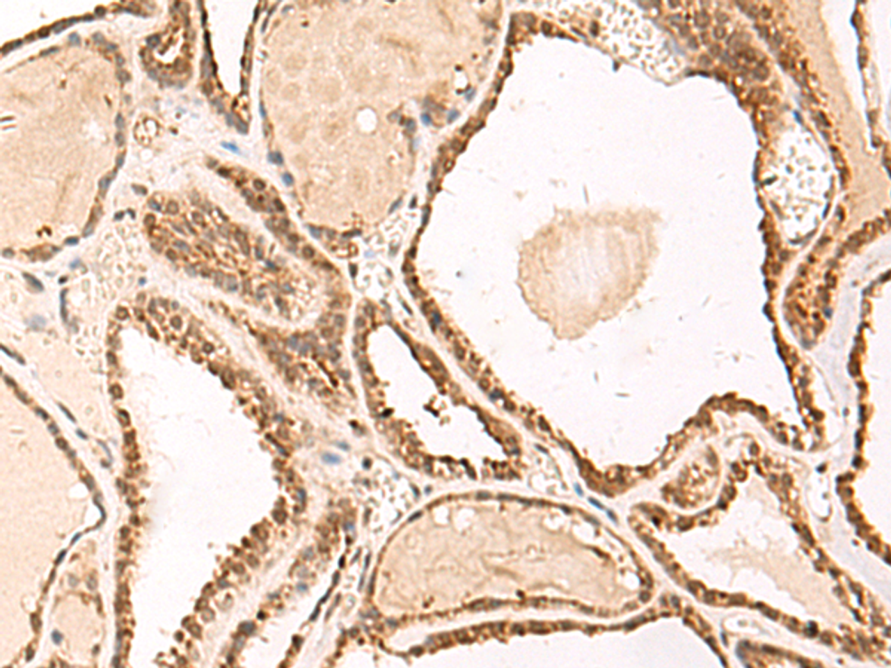 Immunohistochemistry of paraffin-embedded Human thyroid cancer tissue  using FUNDC2 Polyclonal Antibody at dilution of 1:50(×200)