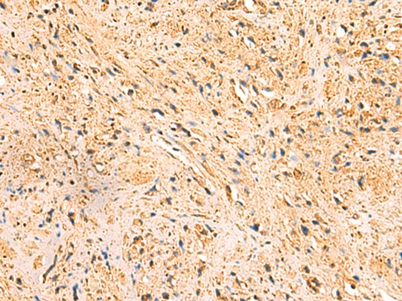 Immunohistochemistry of paraffin-embedded Human prost at e cancer tissue  using RTN1 Polyclonal Antibody at dilution of 1:50(×200)