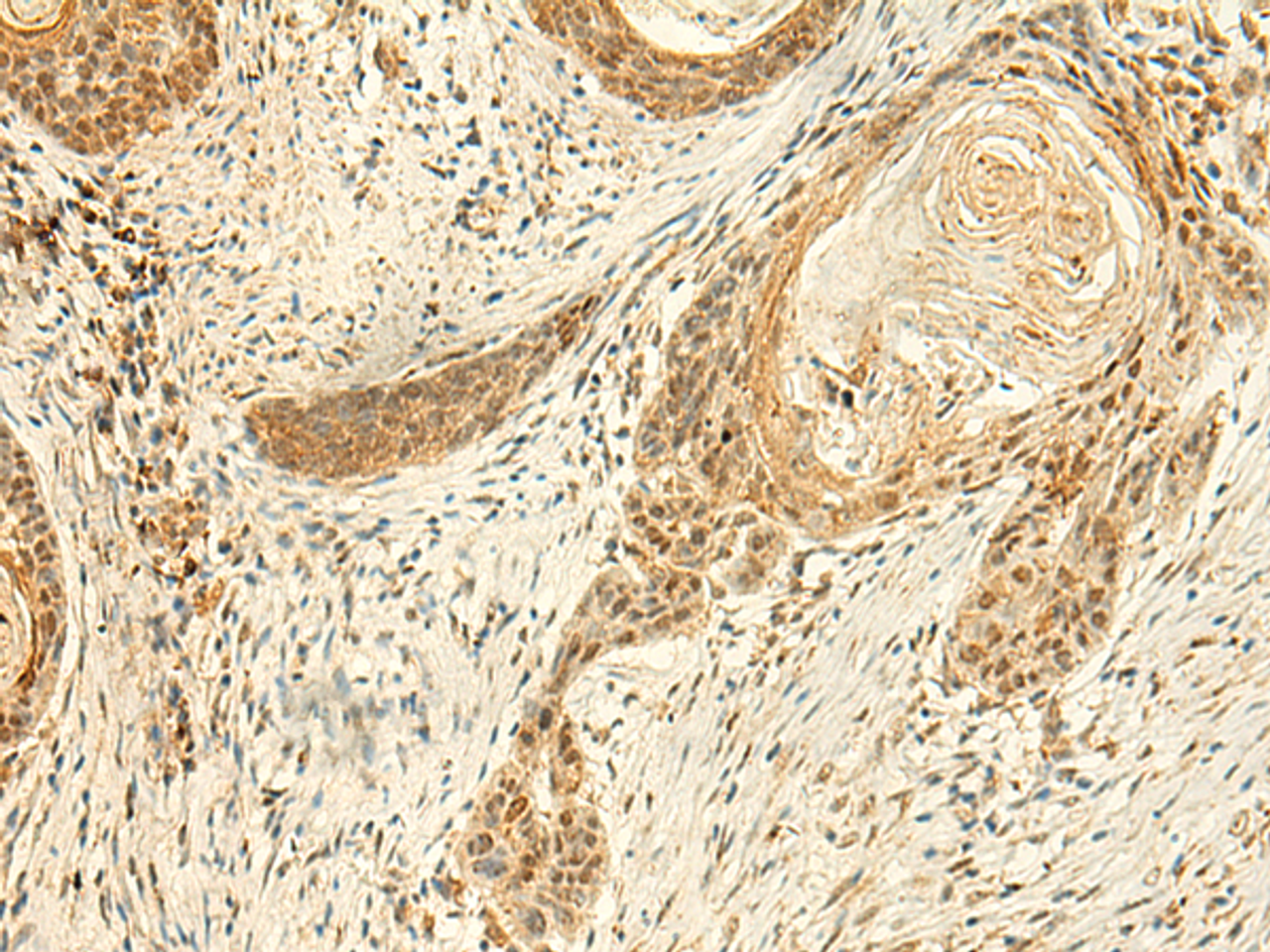 Immunohistochemistry of paraffin-embedded Human esophagus cancer tissue  using ARL4D Polyclonal Antibody at dilution of 1:50(×200)