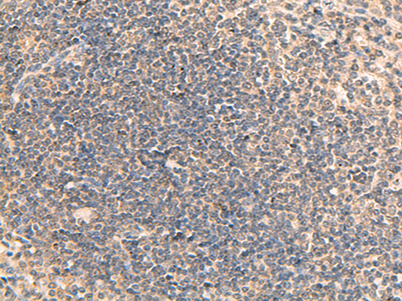 Immunohistochemistry of paraffin-embedded Human tonsil tissue  using RPL13A Polyclonal Antibody at dilution of 1:95(×200)