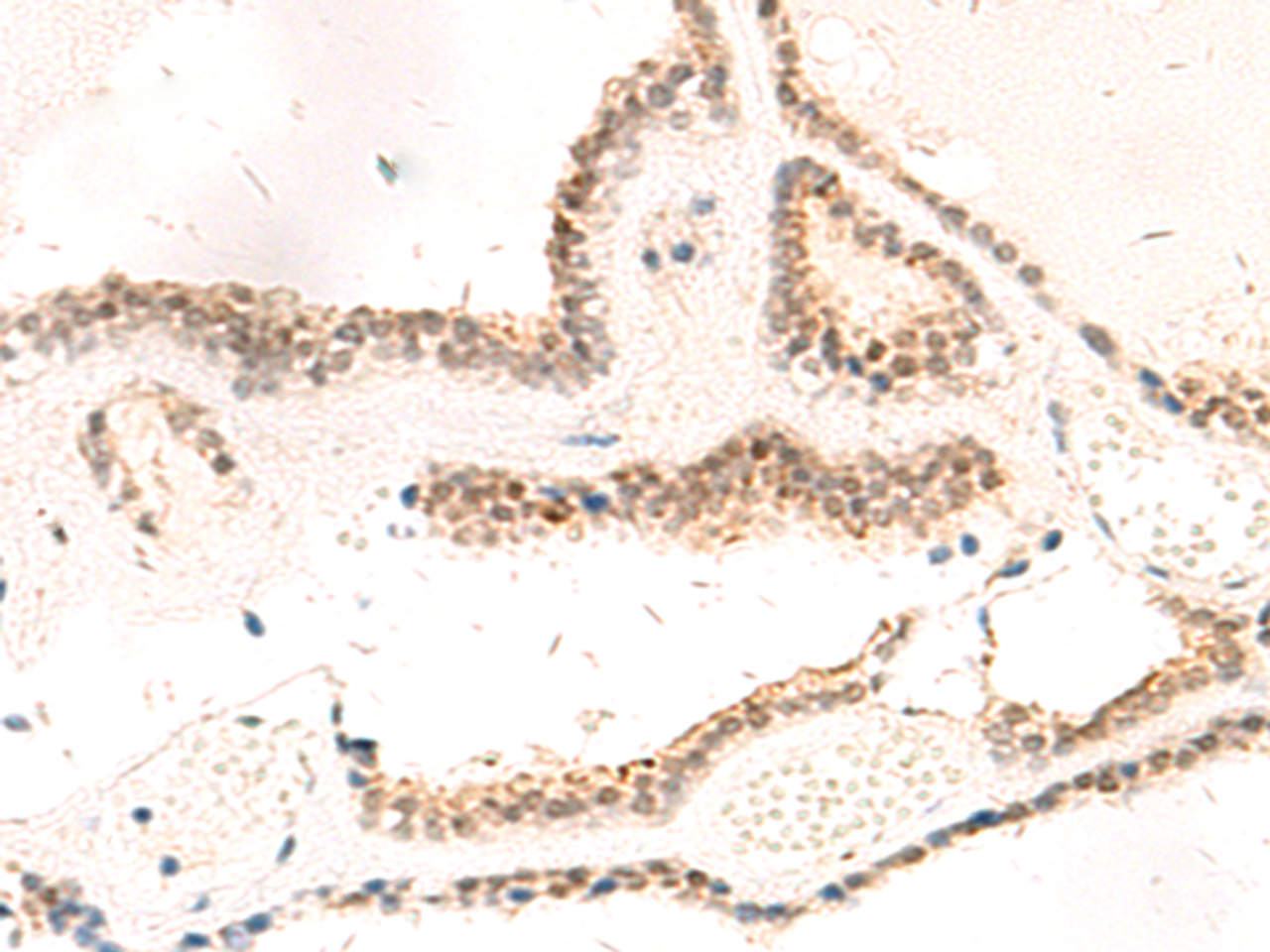 Immunohistochemistry of paraffin-embedded Human thyroid cancer tissue  using RPL13A Polyclonal Antibody at dilution of 1:95(×200)