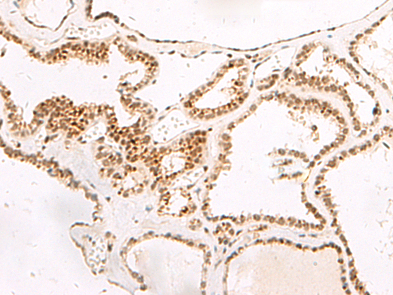 Immunohistochemistry of paraffin-embedded Human thyroid cancer tissue  using DGCR6L Polyclonal Antibody at dilution of 1:65(×200)