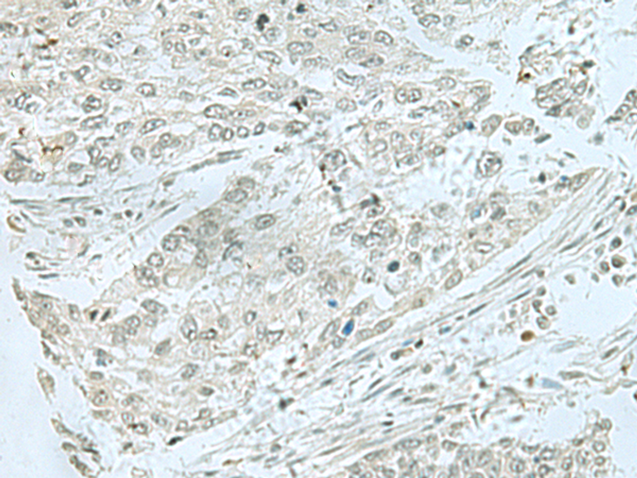 Immunohistochemistry of paraffin-embedded Human lung cancer tissue  using THTPA Polyclonal Antibody at dilution of 1:70(×200)