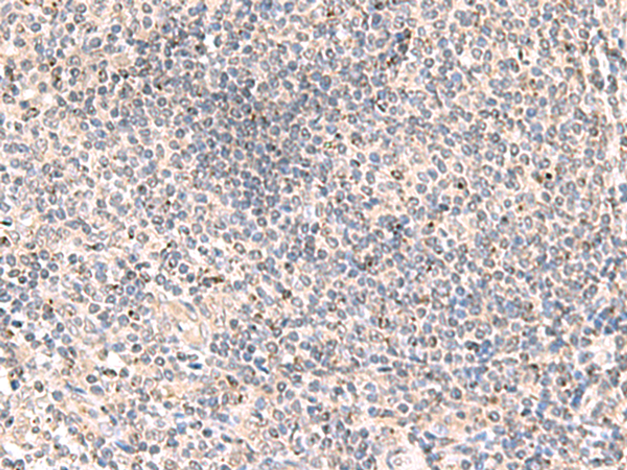 Immunohistochemistry of paraffin-embedded Human tonsil tissue  using MLKL Polyclonal Antibody at dilution of 1:85(×200)