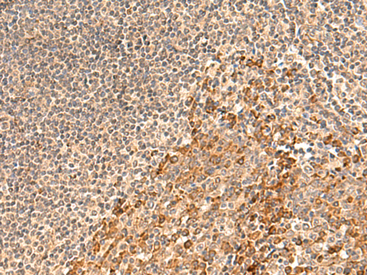 Immunohistochemistry of paraffin-embedded Human tonsil tissue  using GALNT12 Polyclonal Antibody at dilution of 1:60(×200)