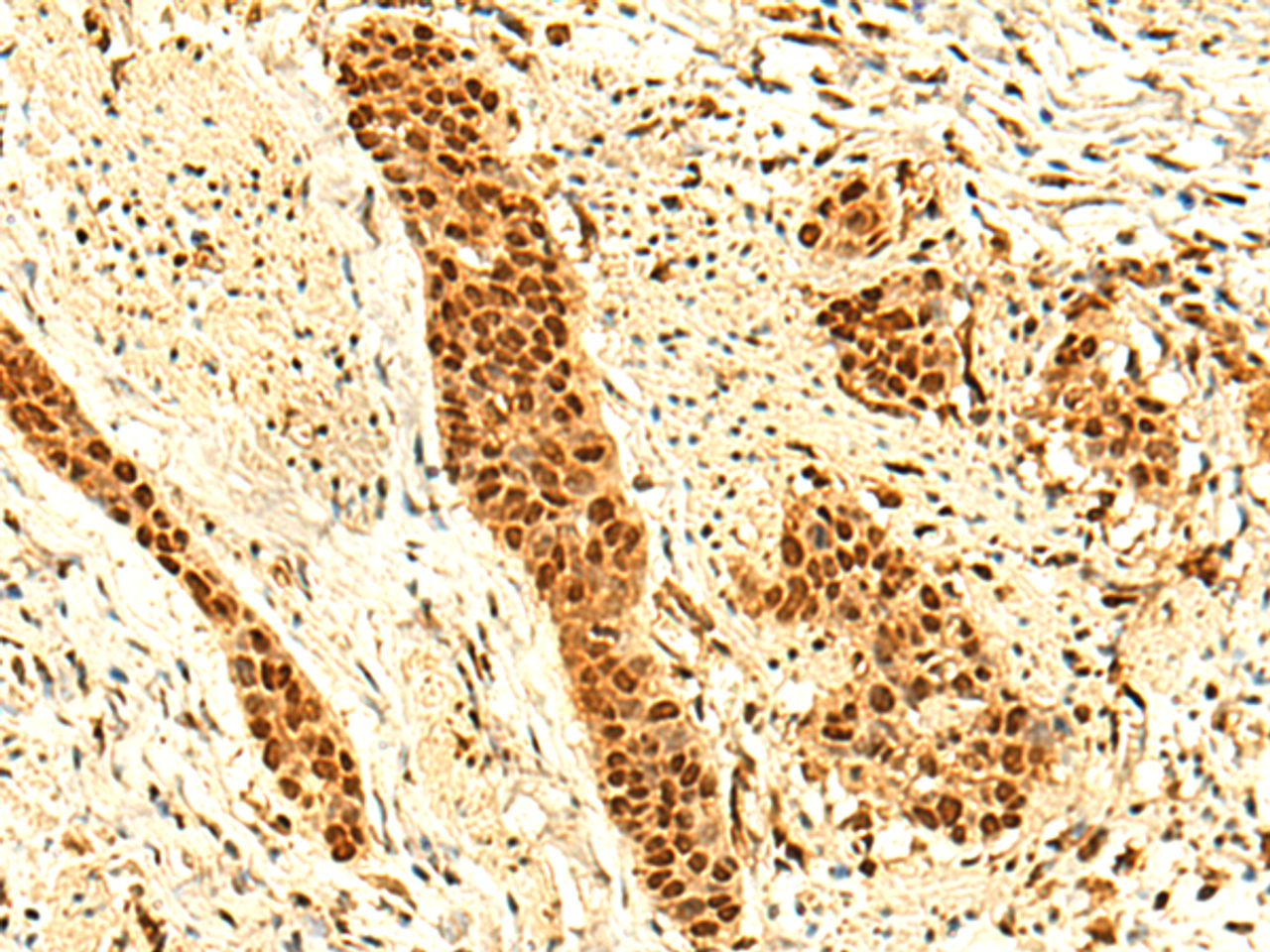 Immunohistochemistry of paraffin-embedded Human esophagus cancer tissue  using UNKL Polyclonal Antibody at dilution of 1:50(×200)