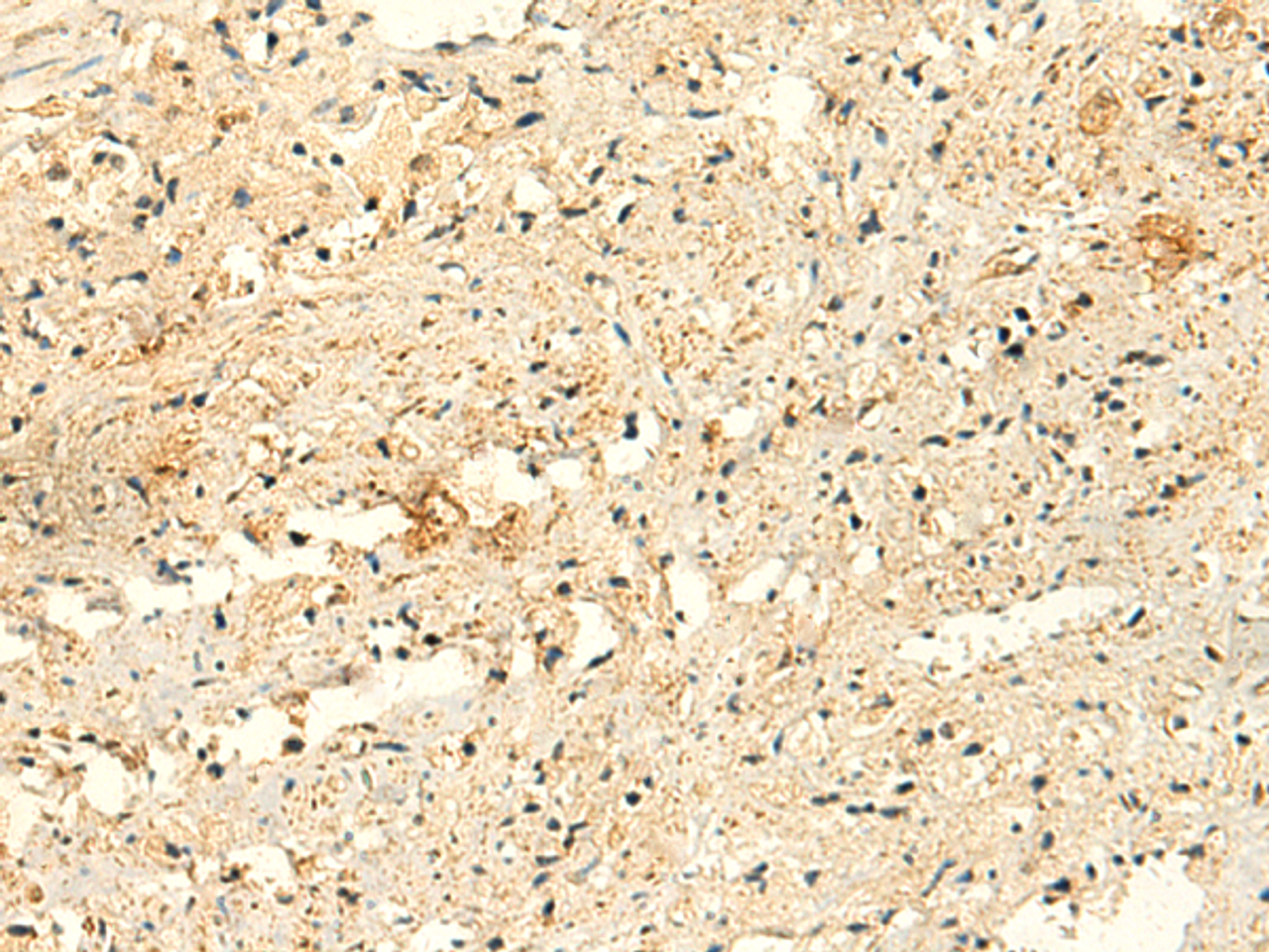 Immunohistochemistry of paraffin-embedded Human prost ate cancer tissue  using GLYATL2 Polyclonal Antibody at dilution of 1:50(×200)