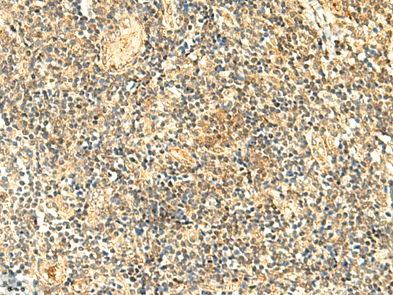 Immunohistochemistry of paraffin-embedded Human tonsil tissue  using NKD2 Polyclonal Antibody at dilution of 1:50(×200)