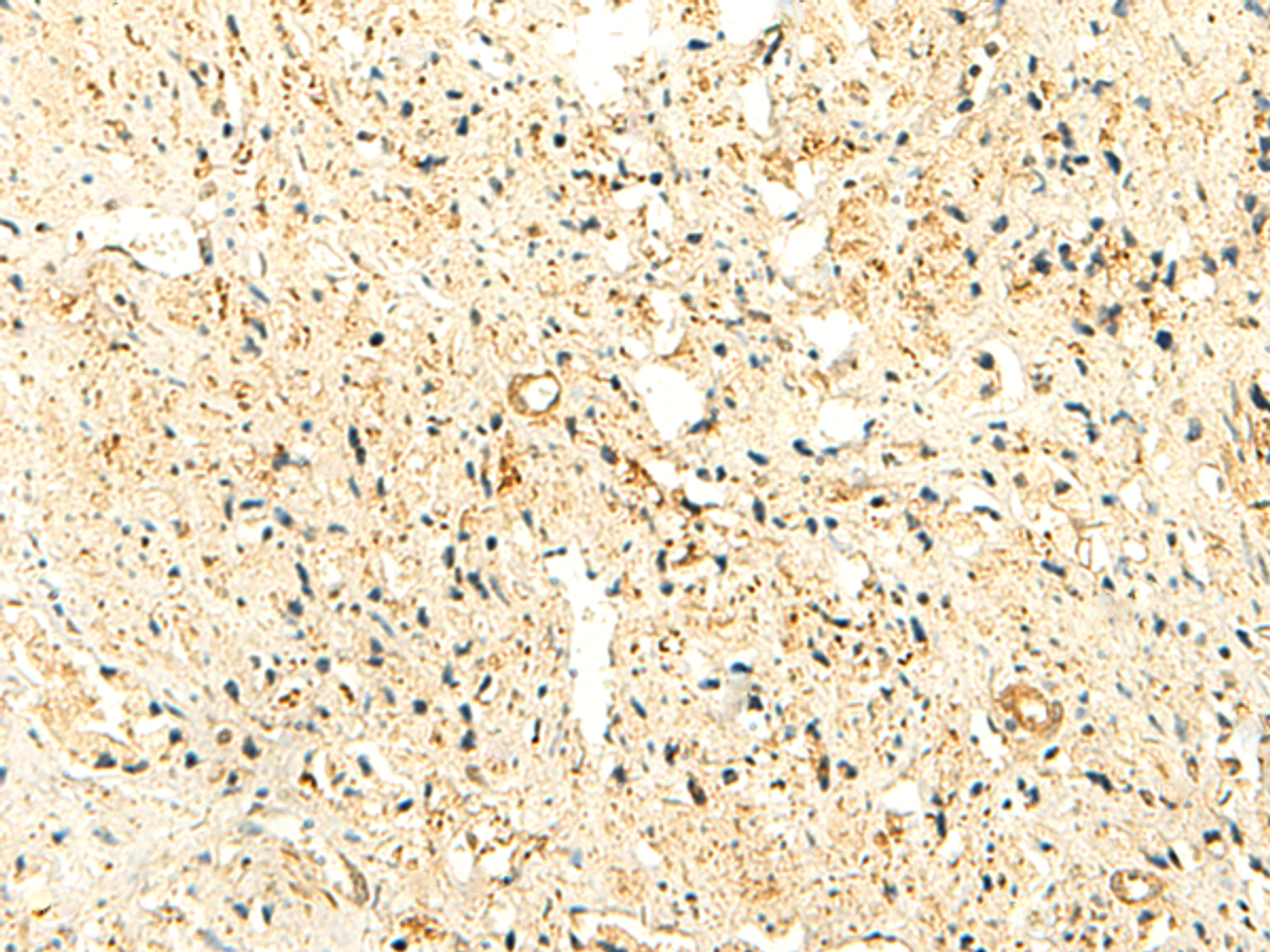Immunohistochemistry of paraffin-embedded Human prost ate cancer tissue  using NKD2 Polyclonal Antibody at dilution of 1:50(×200)