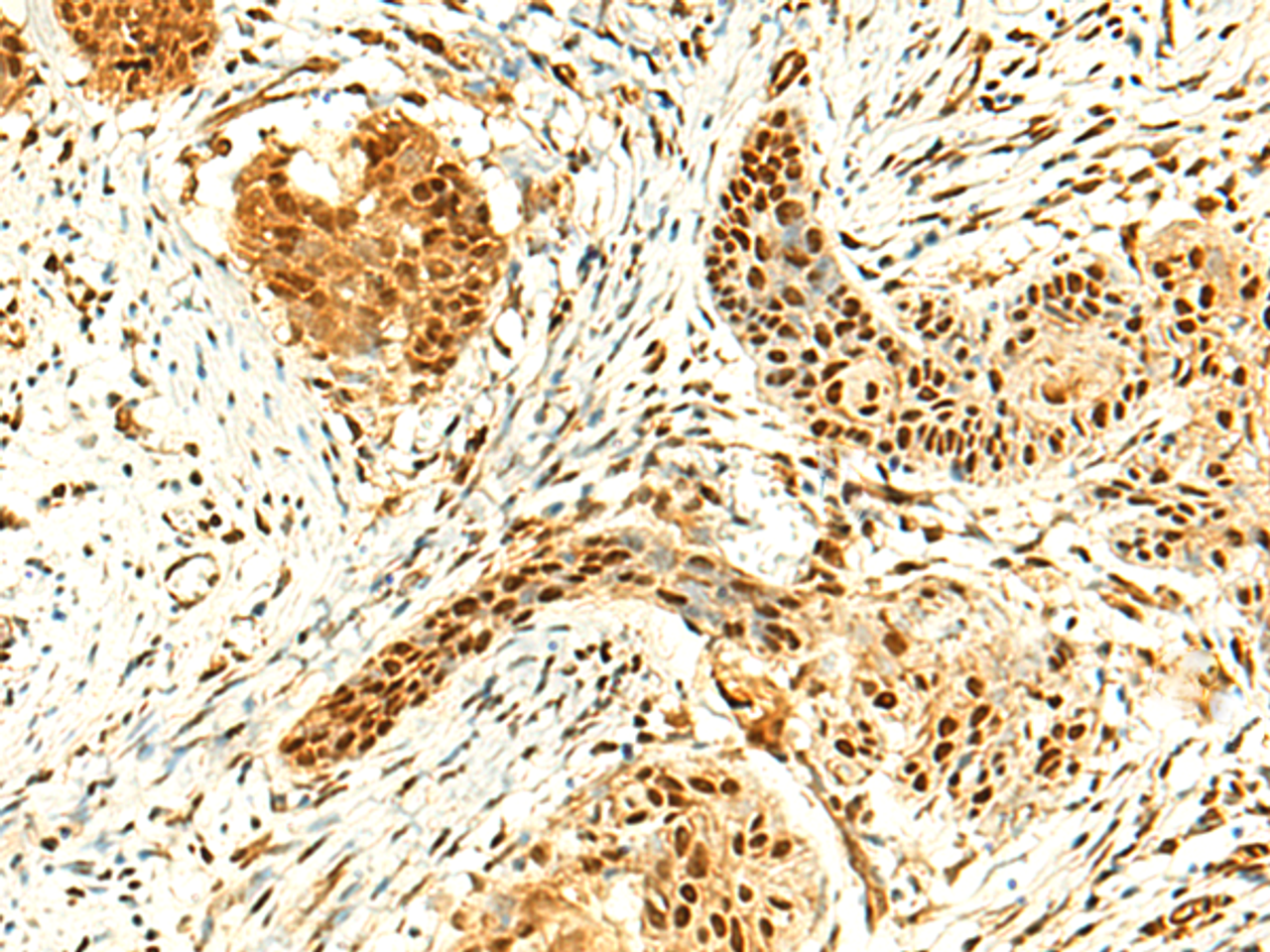 Immunohistochemistry of paraffin-embedded Human esophagus cancer tissue  using POLR3F Polyclonal Antibody at dilution of 1:50(×200)