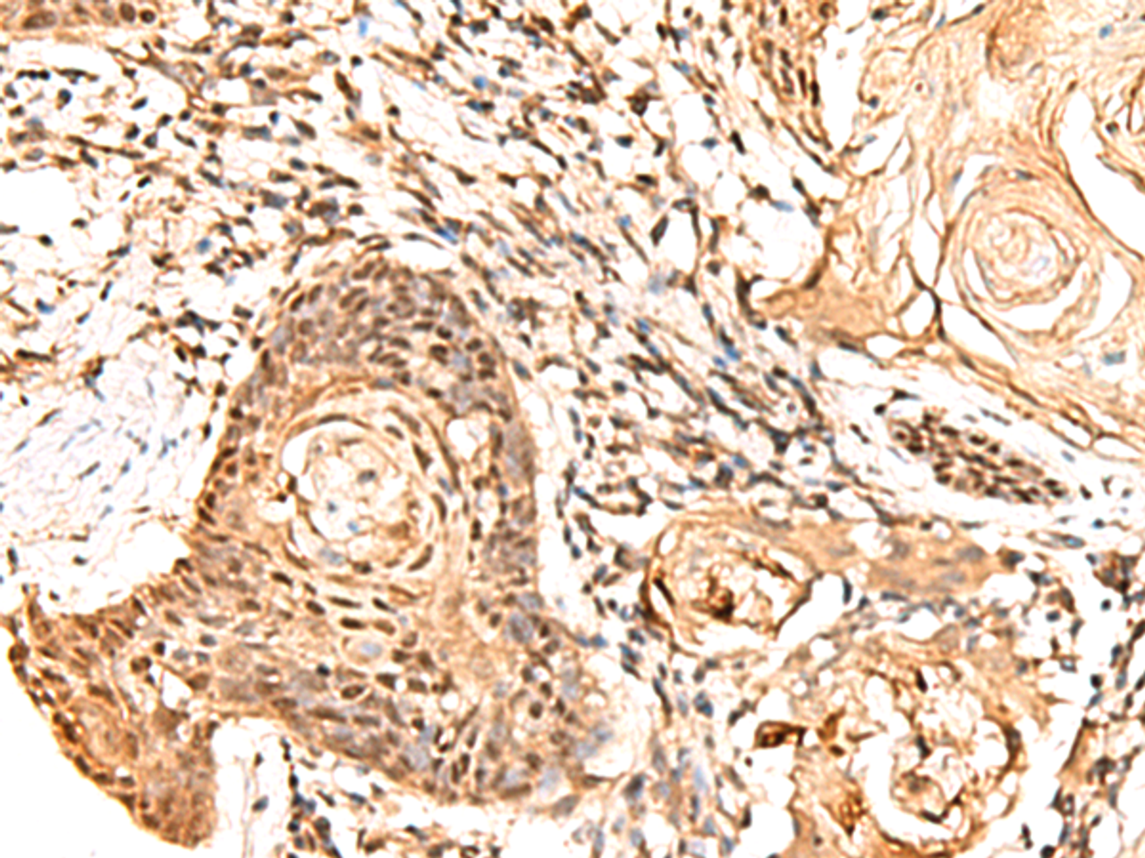 Immunohistochemistry of paraffin-embedded Human esophagus cancer tissue  using RETREG1 Polyclonal Antibody at dilution of 1:60(×200)