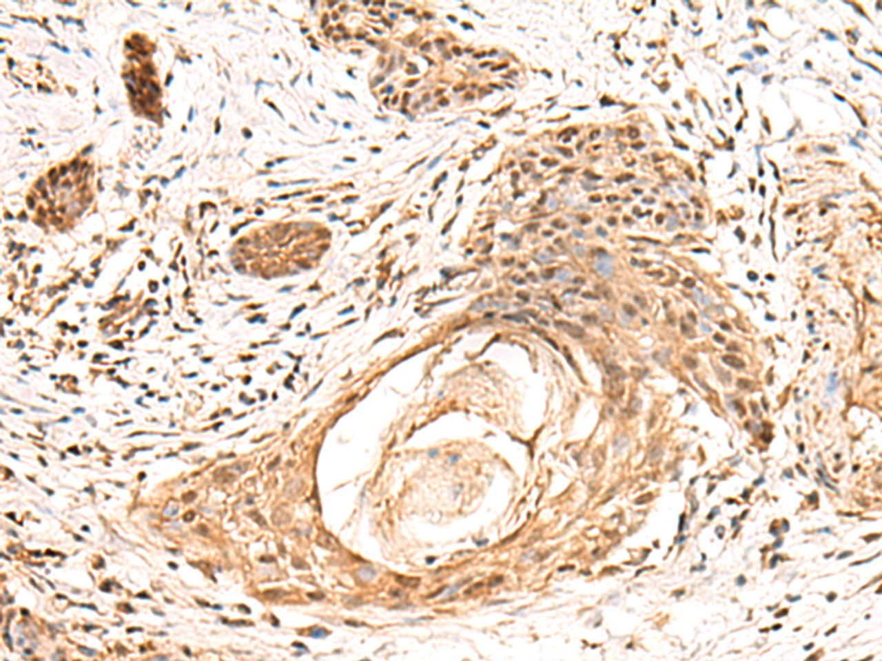 Immunohistochemistry of paraffin-embedded Human esophagus cancer tissue  using KCTD13 Polyclonal Antibody at dilution of 1:55(×200)