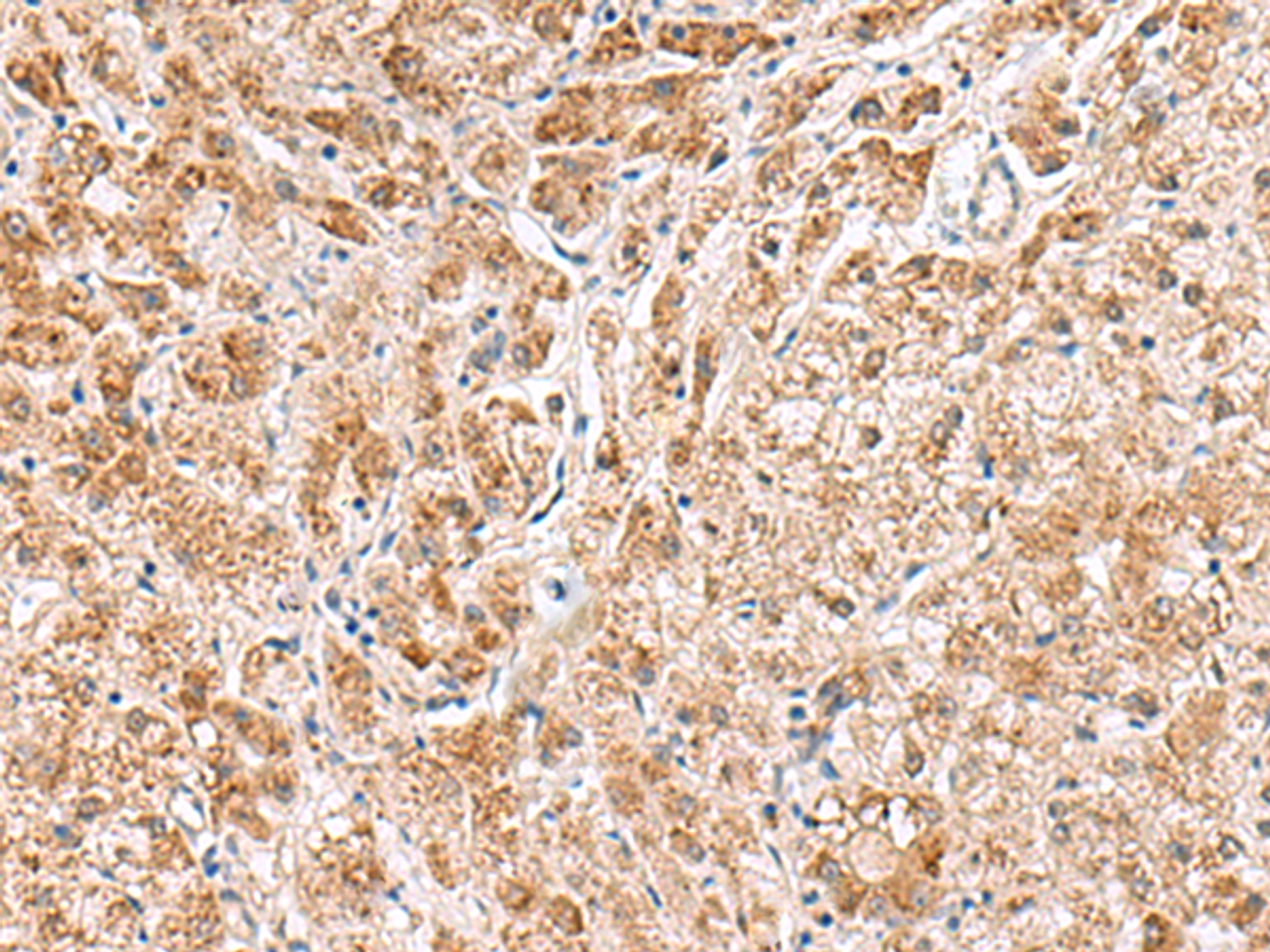 Immunohistochemistry of paraffin-embedded Human liver cancer tissue  using HMGCLL1 Polyclonal Antibody at dilution of 1:60(×200)
