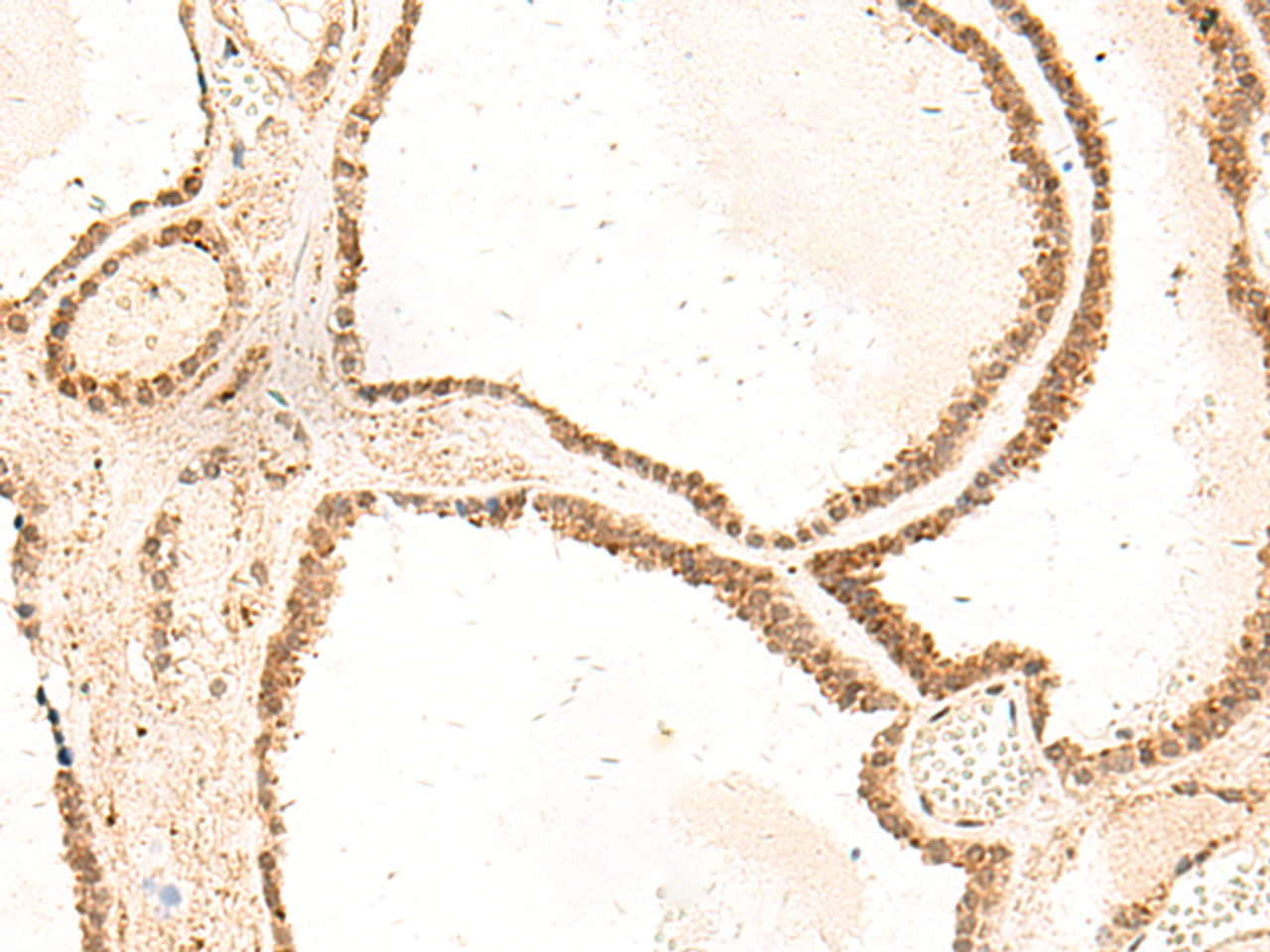 Immunohistochemistry of paraffin-embedded Human thyroid cancer tissue  using ZFYVE27 Polyclonal Antibody at dilution of 1:50(×200)