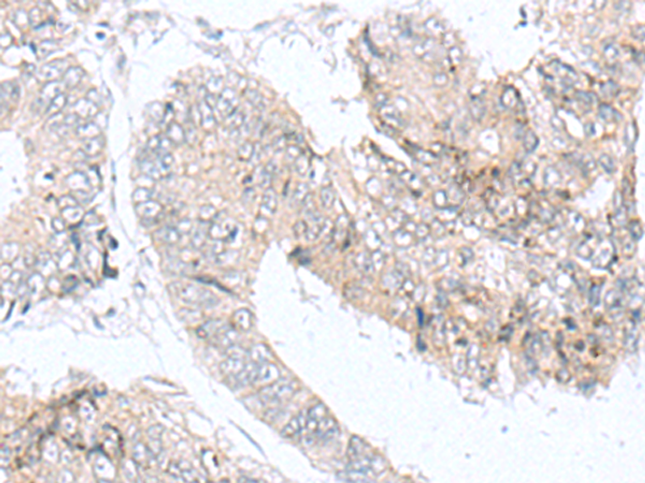 Immunohistochemistry of paraffin-embedded Human colorectal cancer tissue  using IQCD Polyclonal Antibody at dilution of 1:90(×200)