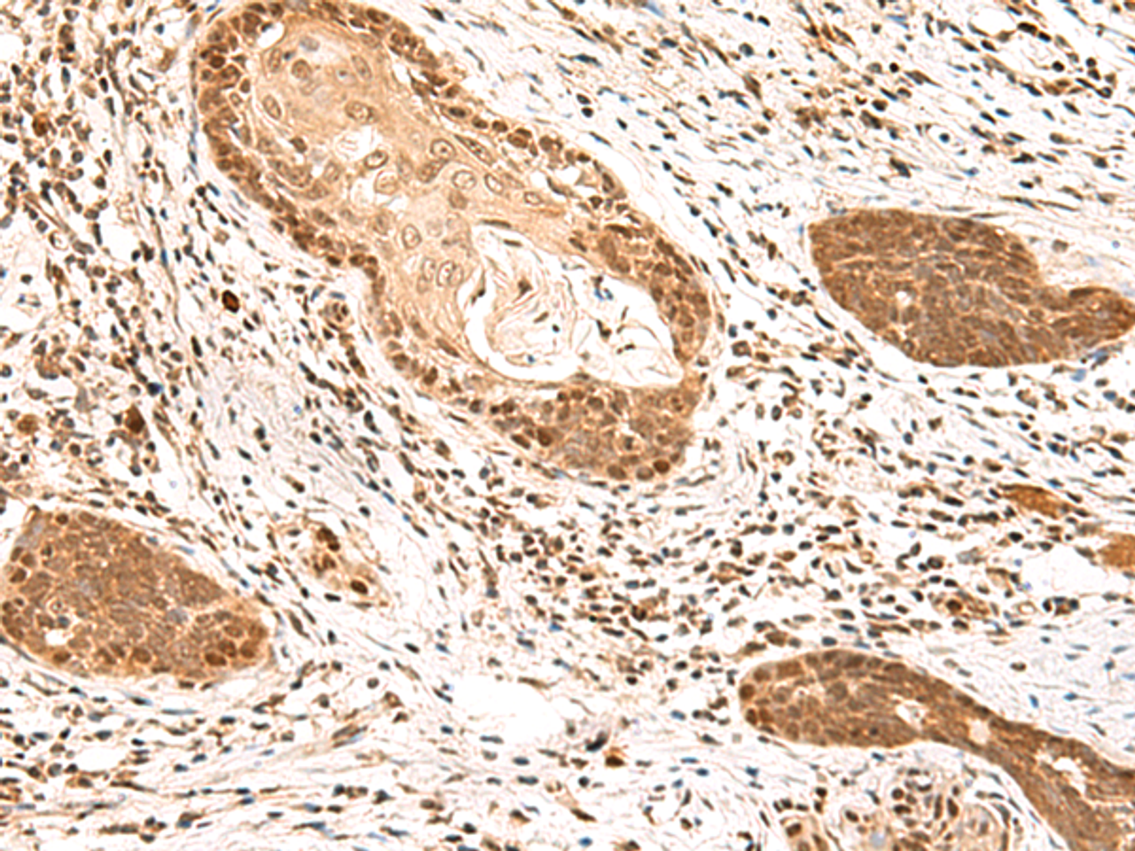 Immunohistochemistry of paraffin-embedded Human esophagus cancer tissue  using MKX Polyclonal Antibody at dilution of 1:60(×200)