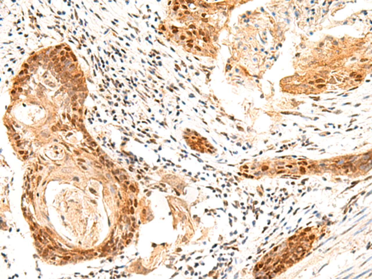 Immunohistochemistry of paraffin-embedded Human esophagus cancer tissue  using SETMAR Polyclonal Antibody at dilution of 1:60(×200)