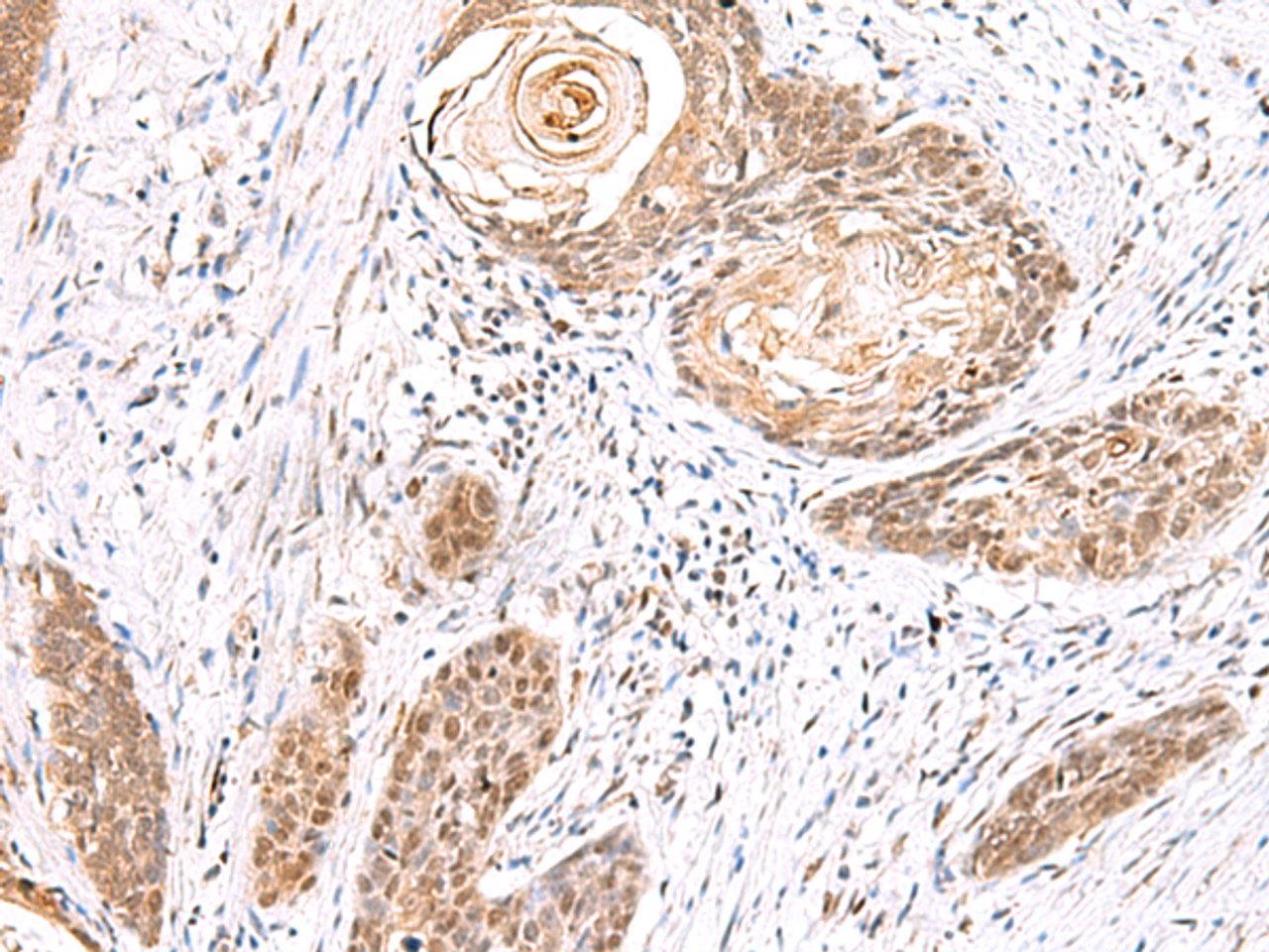 Immunohistochemistry of paraffin-embedded Human esophagus cancer tissue  using EWSR1 Polyclonal Antibody at dilution of 1:70(×200)