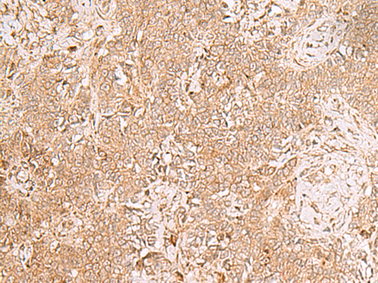 Immunohistochemistry of paraffin-embedded Human ovarian cancer tissue  using GMPPB Polyclonal Antibody at dilution of 1:50(×200)