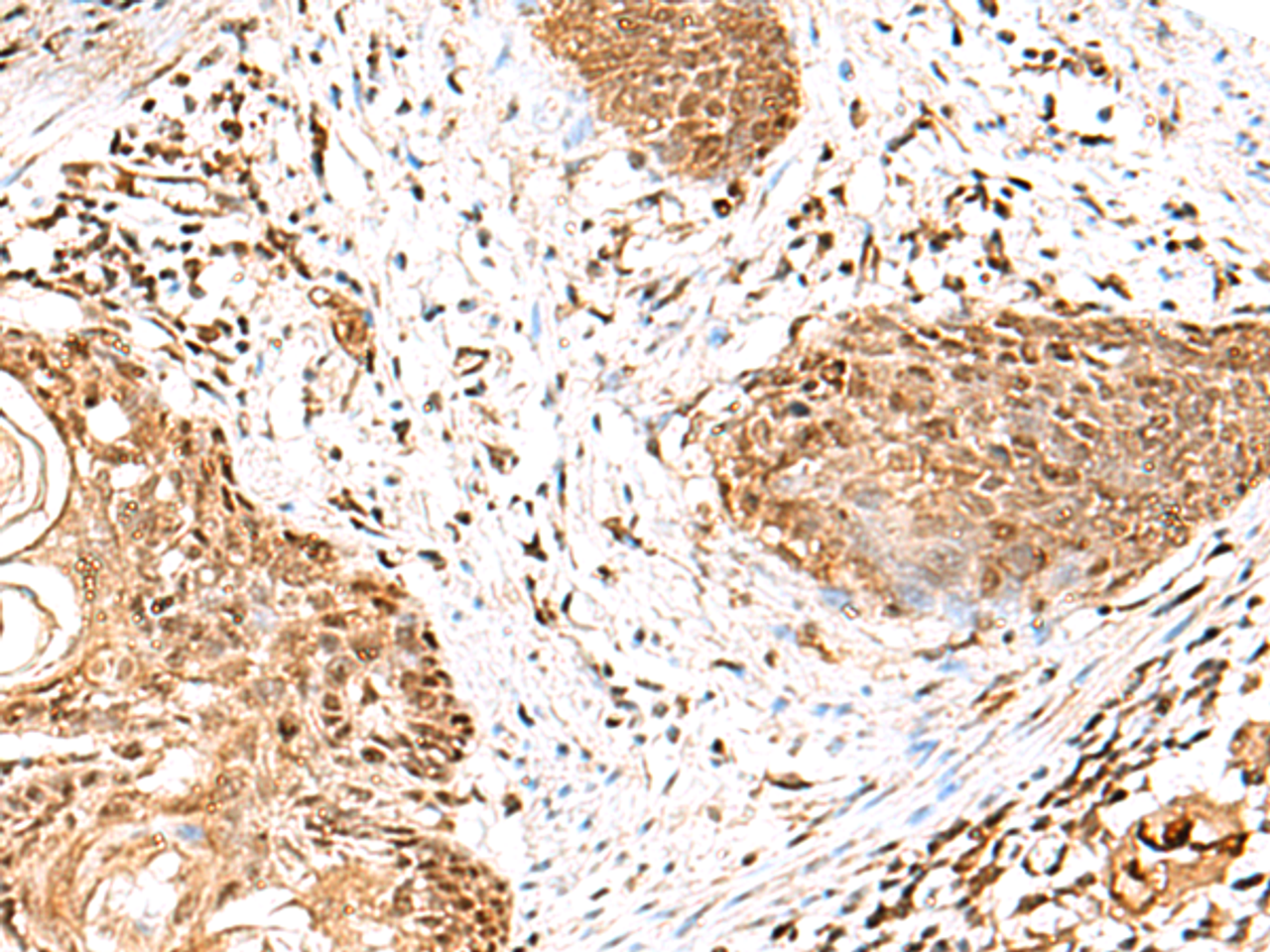 Immunohistochemistry of paraffin-embedded Human esophagus cancer tissue  using GMPPB Polyclonal Antibody at dilution of 1:50(×200)