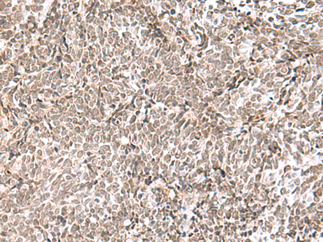Immunohistochemistry of paraffin-embedded Human lung cancer tissue  using ELAC1 Polyclonal Antibody at dilution of 1:65(×200)