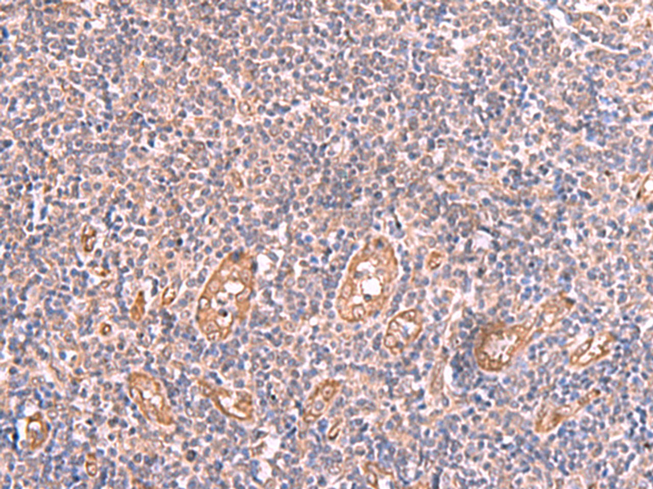 Immunohistochemistry of paraffin-embedded Human tonsil tissue  using LMCD1 Polyclonal Antibody at dilution of 1:100(×200)