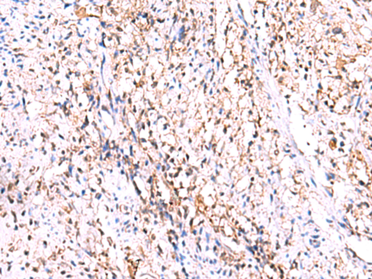 Immunohistochemistry of paraffin-embedded Human cervical cancer tissue  using GMDS Polyclonal Antibody at dilution of 1:70(×200)