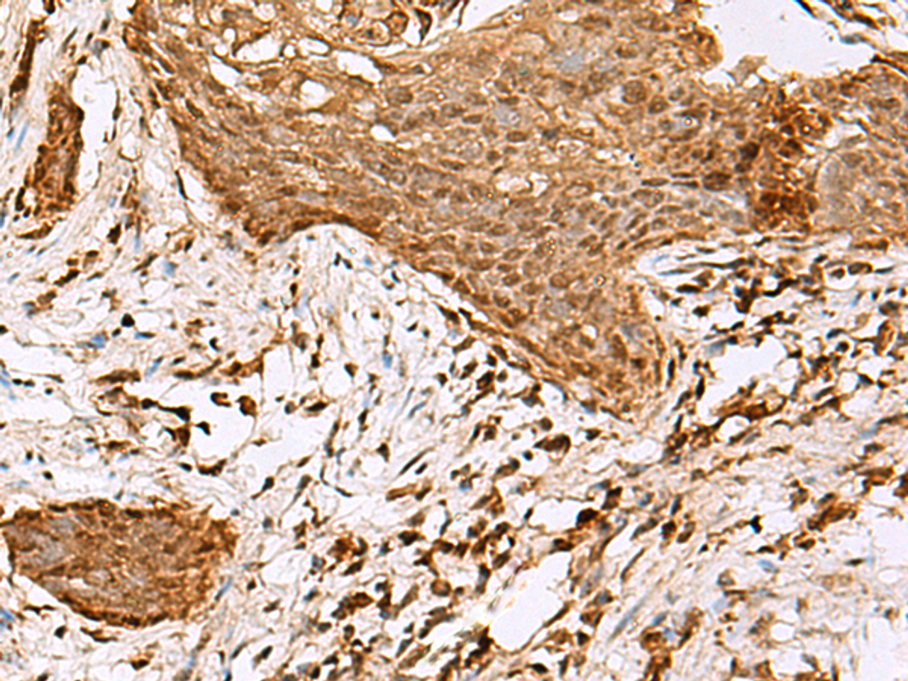 Immunohistochemistry of paraffin-embedded Human esophagus cancer tissue  using SAMSN1 Polyclonal Antibody at dilution of 1:80(×200)