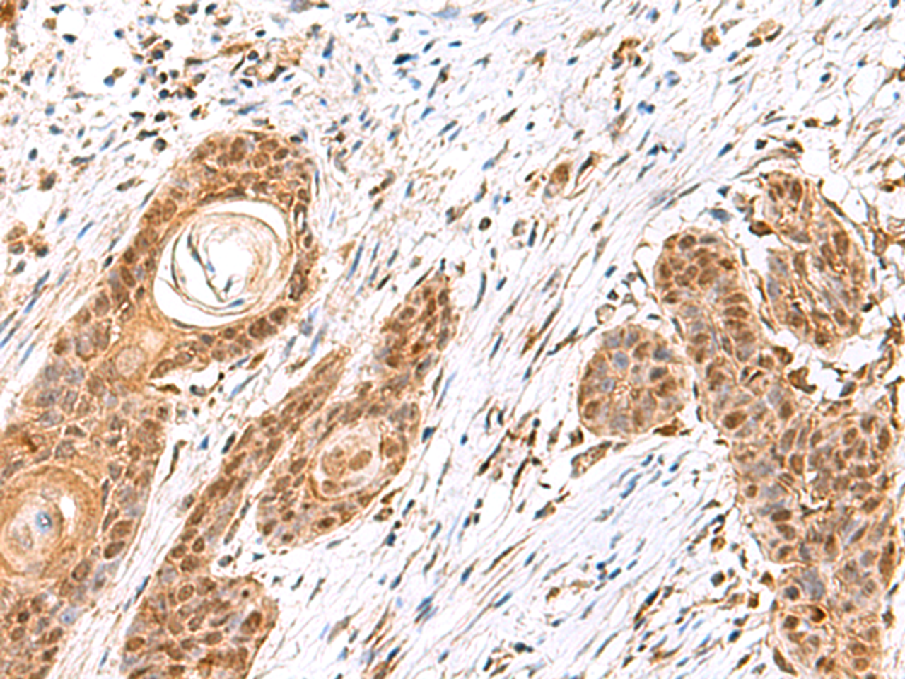 Immunohistochemistry of paraffin-embedded Human esophagus cancer tissue  using MECR Polyclonal Antibody at dilution of 1:60(×200)