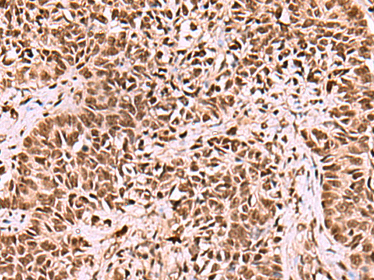 Immunohistochemistry of paraffin-embedded Human ovarian cancer tissue  using LDB1 Polyclonal Antibody at dilution of 1:70(×200)