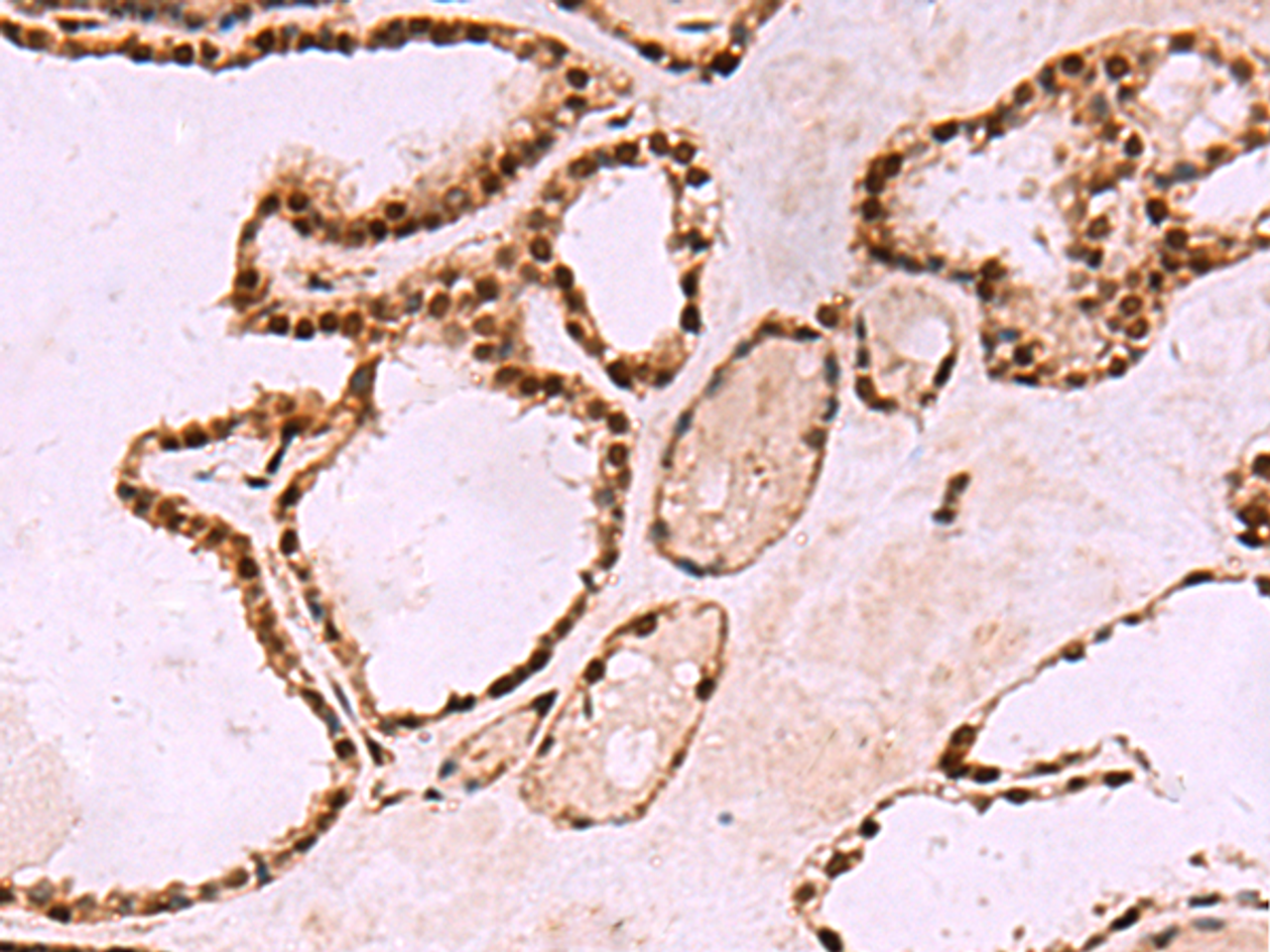 Immunohistochemistry of paraffin-embedded Human thyroid cancer tissue  using LDB1 Polyclonal Antibody at dilution of 1:70(×200)