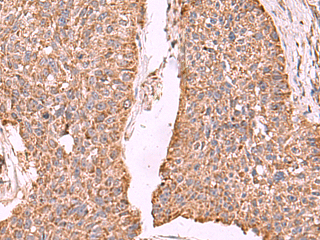 Immunohistochemistry of paraffin-embedded Human esophagus cancer tissue  using PER3 Polyclonal Antibody at dilution of 1:55(×200)