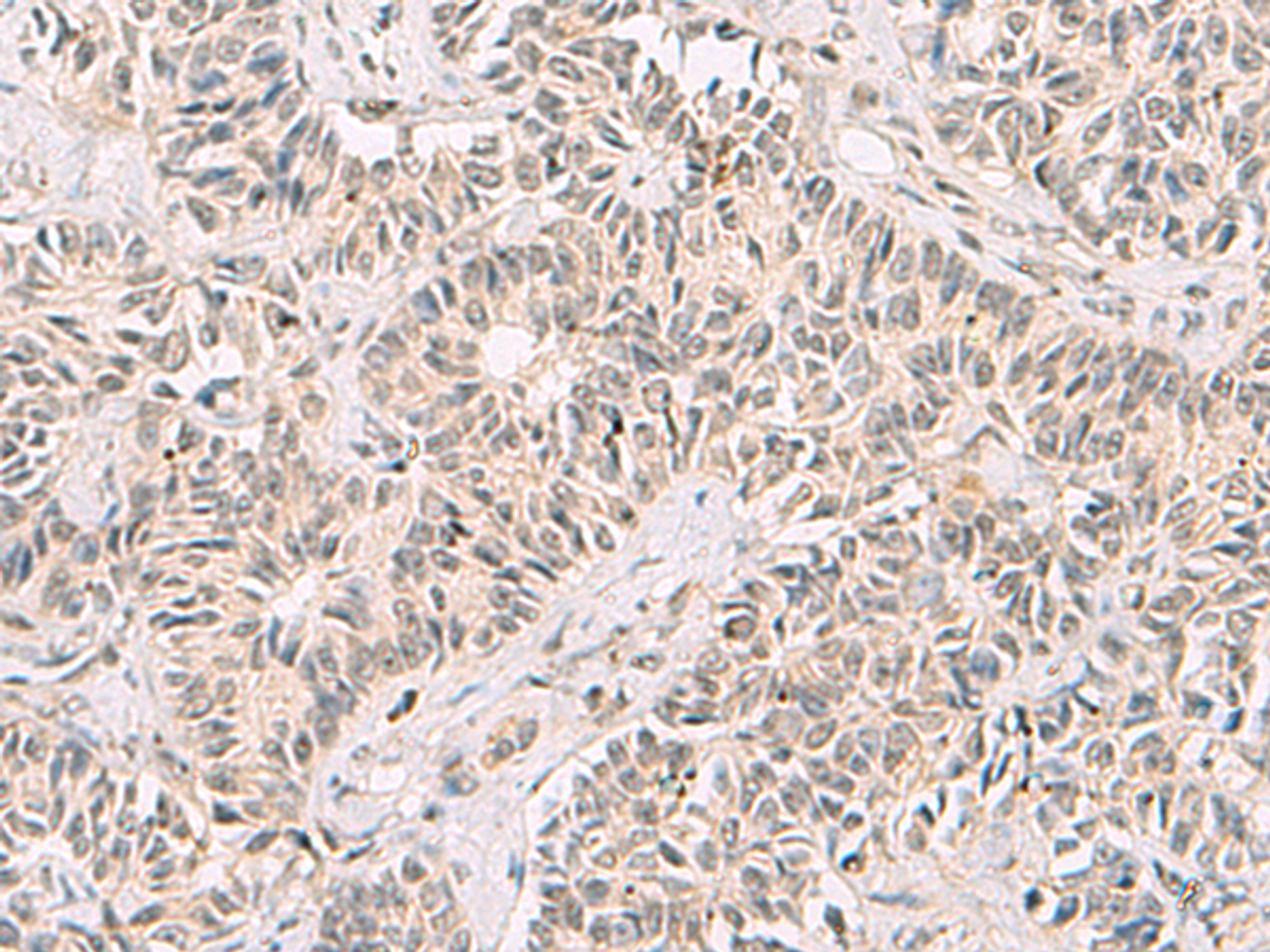 Immunohistochemistry of paraffin-embedded Human ovarian cancer tissue  using RNF13 Polyclonal Antibody at dilution of 1:60(×200)