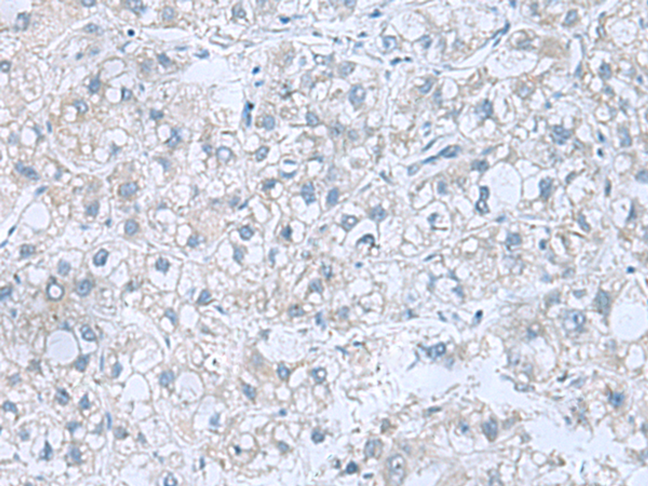 Immunohistochemistry of paraffin-embedded Human liver cancer tissue  using ATP6V1C1 Polyclonal Antibody at dilution of 1:100(×200)