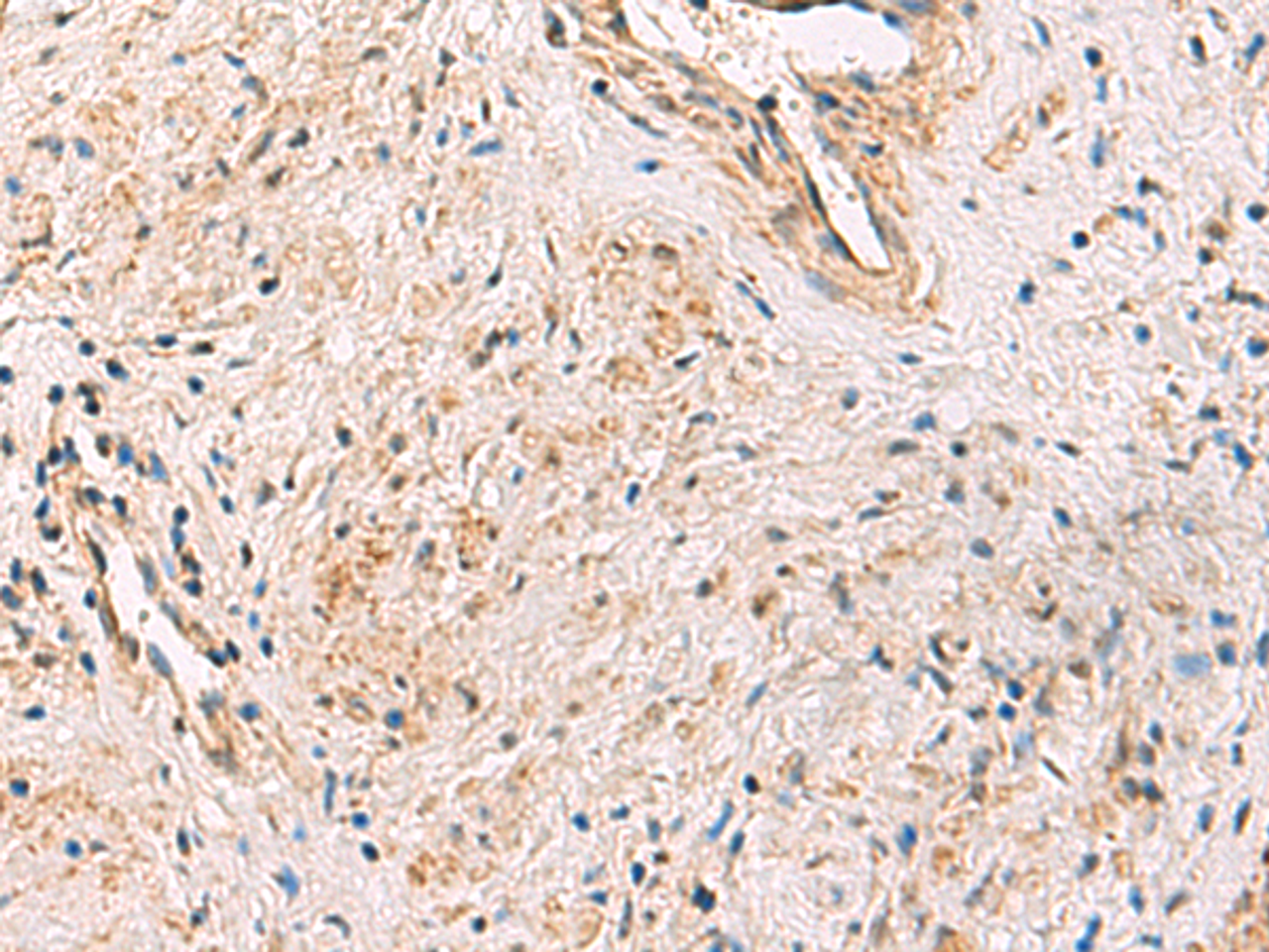 Immunohistochemistry of paraffin-embedded Human prost ate cancer tissue  using PCYT2 Polyclonal Antibody at dilution of 1:55(×200)