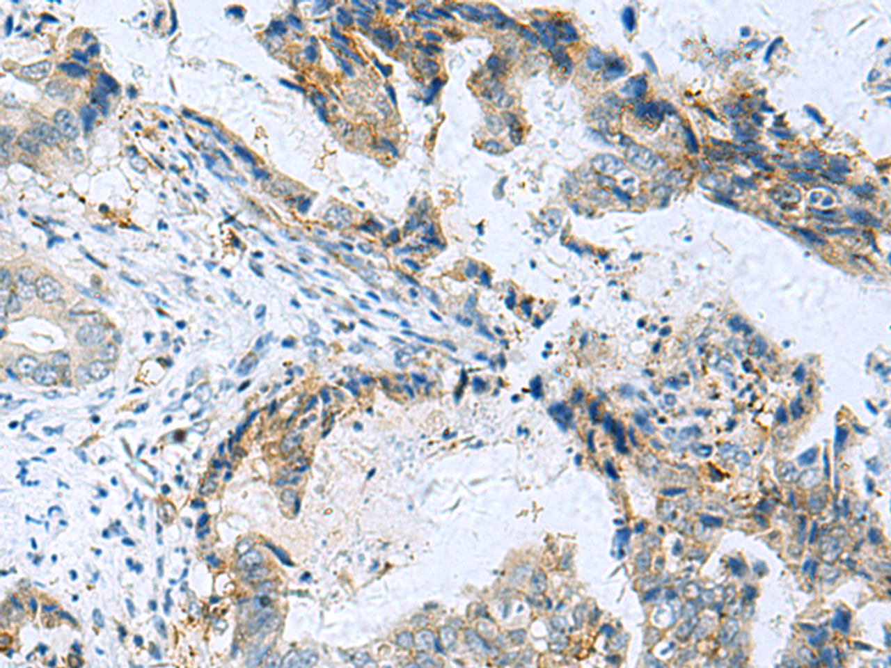 Immunohistochemistry of paraffin-embedded Human cervical cancer tissue  using RMDN2 Polyclonal Antibody at dilution of 1:70(×200)