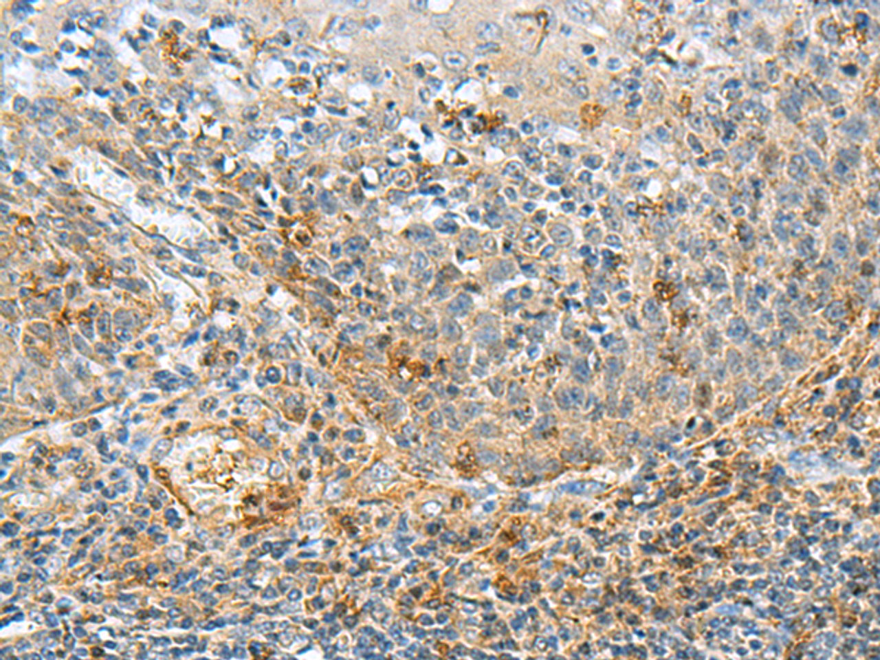 Immunohistochemistry of paraffin-embedded Human tonsil tissue  using RMDN2 Polyclonal Antibody at dilution of 1:70(×200)