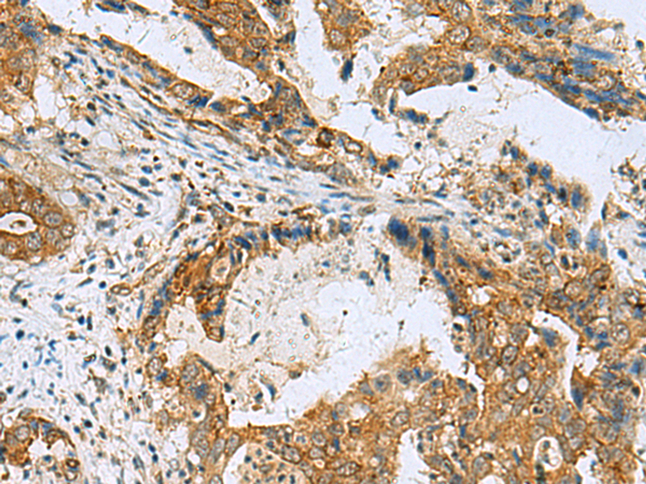 Immunohistochemistry of paraffin-embedded Human cervical cancer tissue  using TUBD1 Polyclonal Antibody at dilution of 1:70(×200)
