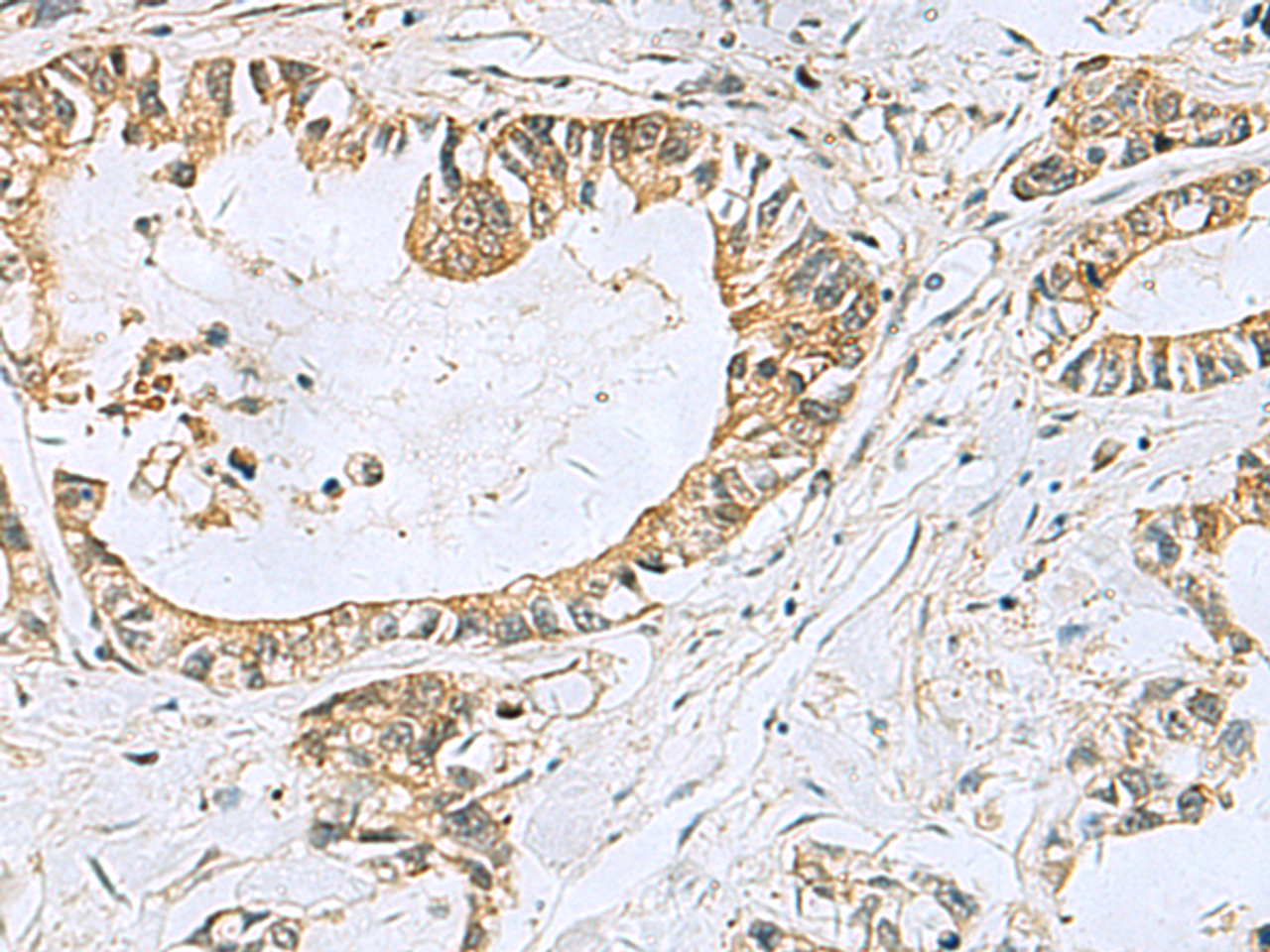 Immunohistochemistry of paraffin-embedded Human gastric cancer tissue  using TUBD1 Polyclonal Antibody at dilution of 1:70(×200)