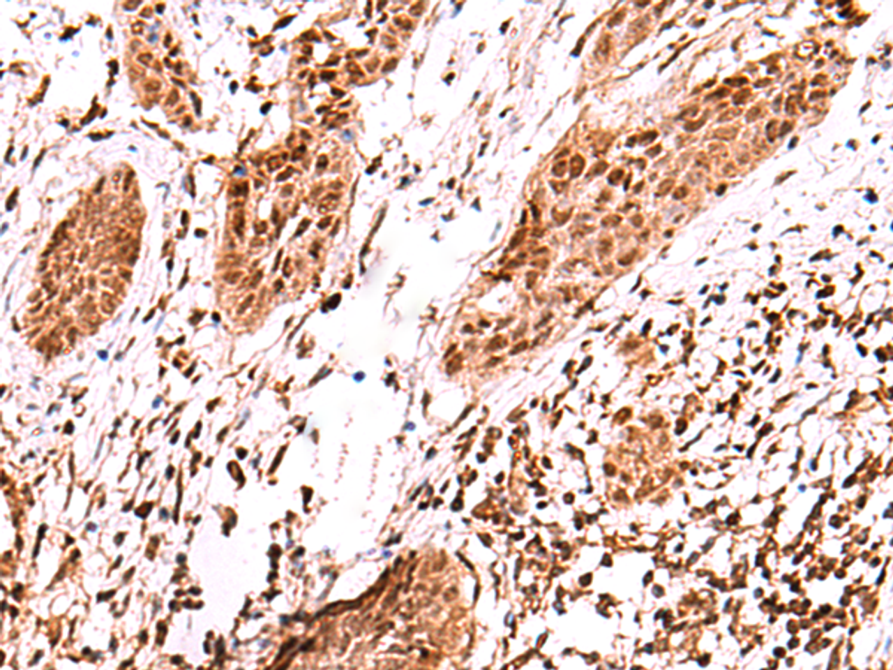 Immunohistochemistry of paraffin-embedded Human esophagus cancer tissue  using AK9 Polyclonal Antibody at dilution of 1:60(×200)