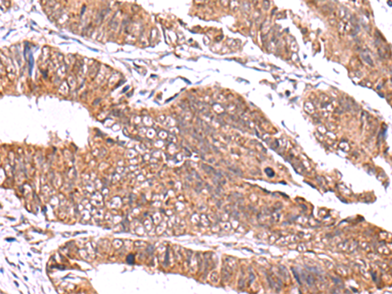 Immunohistochemistry of paraffin-embedded Human colorectal cancer tissue  using GATM Polyclonal Antibody at dilution of 1:70(×200)