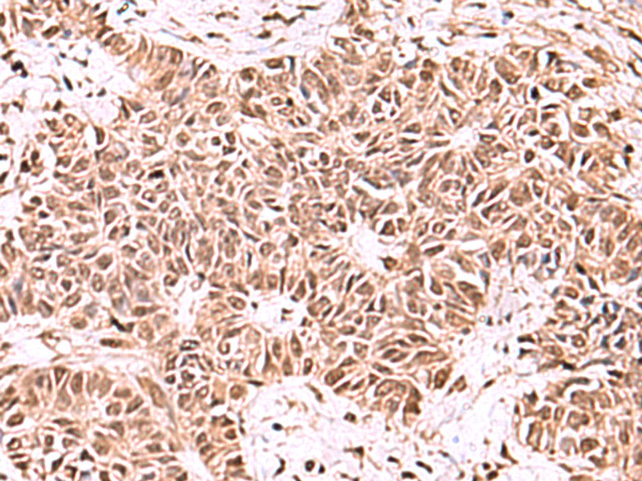 Immunohistochemistry of paraffin-embedded Human ovarian cancer tissue  using ACTL6B Polyclonal Antibody at dilution of 1:100(×200)